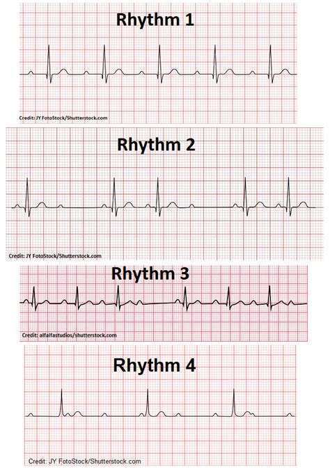 acls rhythm quiz